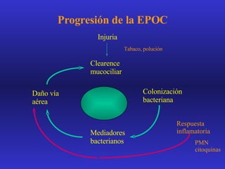Progresión de la EPOC Injuria Tabaco, polución Clearence  mucociliar Colonización bacteriana Mediadores bacterianos Daño vía aérea Respuesta inflamatoria PMN citoquinas 