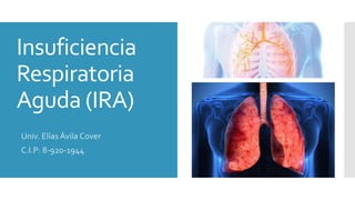 Insuficiencia
Respiratoria
Aguda (IRA)
Univ. Elías Ávila Cover
C.I.P: 8-920-1944
 