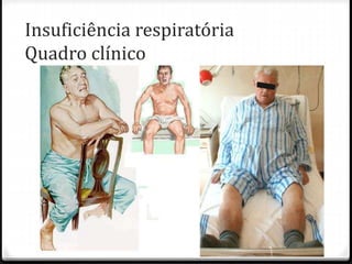 Insuficiência respiratória
Quadro clínico
 