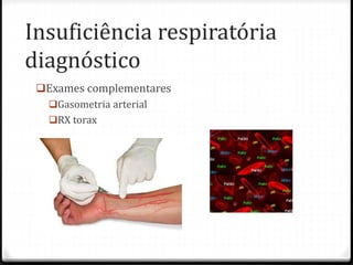 Insuficiência respiratória
diagnóstico
Exames complementares
Gasometria arterial
RX torax
 