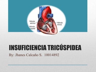 INSUFICIENCIA TRICÚSPIDEA
By: Jhanes Calcaño S. 10014892

 