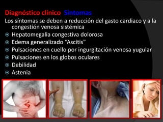 Diagnóstico clínico Síntomas
Los síntomas se deben a reducción del gasto cardiaco y a la
congestión venosa sistémica
 Hepatomegalia congestiva dolorosa
 Edema generalizado “Ascitis”
 Pulsaciones en cuello por ingurgitación venosa yugular
 Pulsaciones en los globos oculares
 Debilidad
 Astenia

 