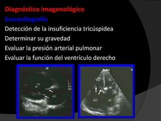 Diagnóstico imagenológico
Ecocardiografía
Detección de la insuficiencia tricúspidea
Determinar su gravedad
Evaluar la presión arterial pulmonar
Evaluar la función del ventrículo derecho

 