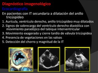 Diagnóstico imagenológico
Ecocardiografía
En pacientes con IT secundaria a dilatación del anillo
tricúspídeo
1. Aurícula, ventrículo derecho, anillo tricúspídeo muy dilatados
2. Signos de sobrecarga del ventrículo derecho diastólica con
movimiento paradójico del tabique interventricular
3. Movimiento exagerado y cierre tardío de válvula tricúspidea
4. Presencia de vegetaciones en las valvas
5. Detección del chorro y magnitud de la IT

 