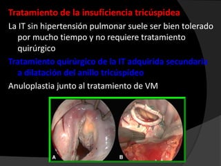 Tratamiento de la insuficiencia tricúspidea
La IT sin hipertensión pulmonar suele ser bien tolerado
por mucho tiempo y no requiere tratamiento
quirúrgico
Tratamiento quirúrgico de la IT adquirida secundaria
a dilatación del anillo tricúspídeo
Anuloplastia junto al tratamiento de VM

 