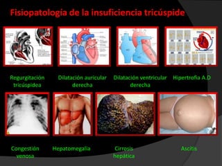 Fisiopatología de la insuficiencia tricúspide

Regurgitación
tricúspidea

Congestión
venosa

Dilatación auricular
derecha

Hepatomegalia

Dilatación ventricular Hipertrofia A.D
derecha

Cirrosis
hepática

Ascitis

 