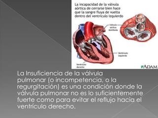 La Insuficiencia de la válvula
pulmonar (o incompetencia, o la
regurgitación) es una condición donde la
válvula pulmonar no es lo suficientemente
fuerte como para evitar el reflujo hacia el
ventrículo derecho.
 