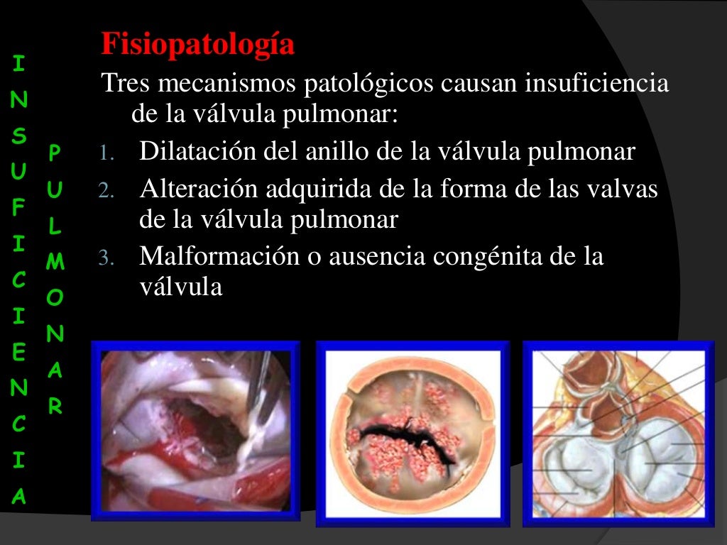 Insuficiencia valvular pulmonar Insuficiencia valvular pulmonar