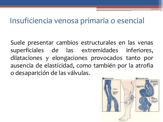 Los grados varikoza de las venas del esófago