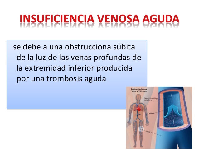 La limpieza de los vasos a la tromboflebitis