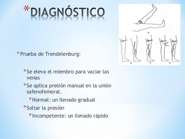 Que por la enfermedad la tromboflebitis y las causas de su surgimiento