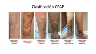 INSUFICIENCIA VENOSA PERIFÉRICA.pptx