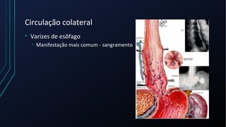Circulação colateral
• Varizes de esôfago
• Manifestação mais comum - sangramento
 