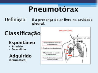 Pneumotórax
É a presença de ar livre na cavidade
pleural.
Classiﬁcação:
Espontâneo
• Primário
• Secundário
Adquirido
(traumático)
Definição:
 