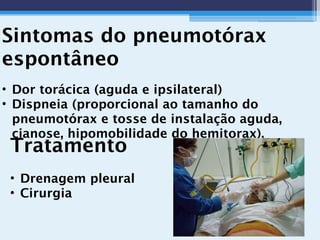 Sintomas do pneumotórax
espontâneo
• Dor torácica (aguda e ipsilateral)
• Dispneia (proporcional ao tamanho do
pneumotórax e tosse de instalação aguda,
cianose, hipomobilidade do hemitorax).
Tratamento
• Drenagem pleural
• Cirurgia
 