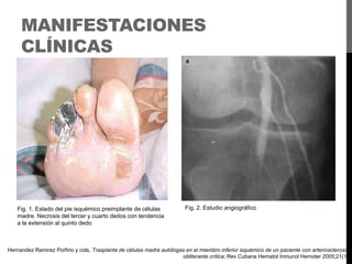 MANIFESTACIONES
CLÍNICAS

Fig. 1. Estado del pie isquémico preimplante de células
madre. Necrosis del tercer y cuarto dedos con tendencia
a la extensión al quinto dedo

Fig. 2. Estudio angiográfico

Hernandez Ramirez Porfirio y cols, Trasplante de células madre autólogas en el miembro inferior isquémico de un paciente con arteriosclerosis
obliterante crítica; Rev Cubana Hematol Inmunol Hemoter 2005;21(1)

 