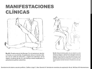 MANIFESTACIONES
CLÍNICAS

Semiotecnia del sistema vascular periférico; Califano Jorge E., Bare Gerardo M. Semiotecnia maniobras de exploración 4ta ed. McGraw Hill Interamericana

 