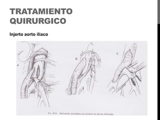 TRATAMIENTO
QUIRURGICO
Injerto aorto iliaco

 