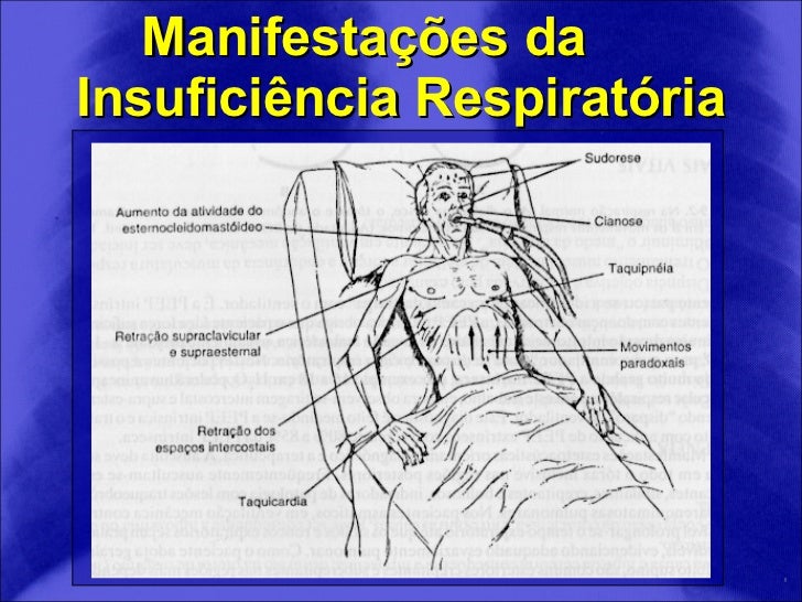 Insuficiência respiratoria