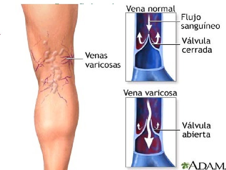 insuficiencia venosa