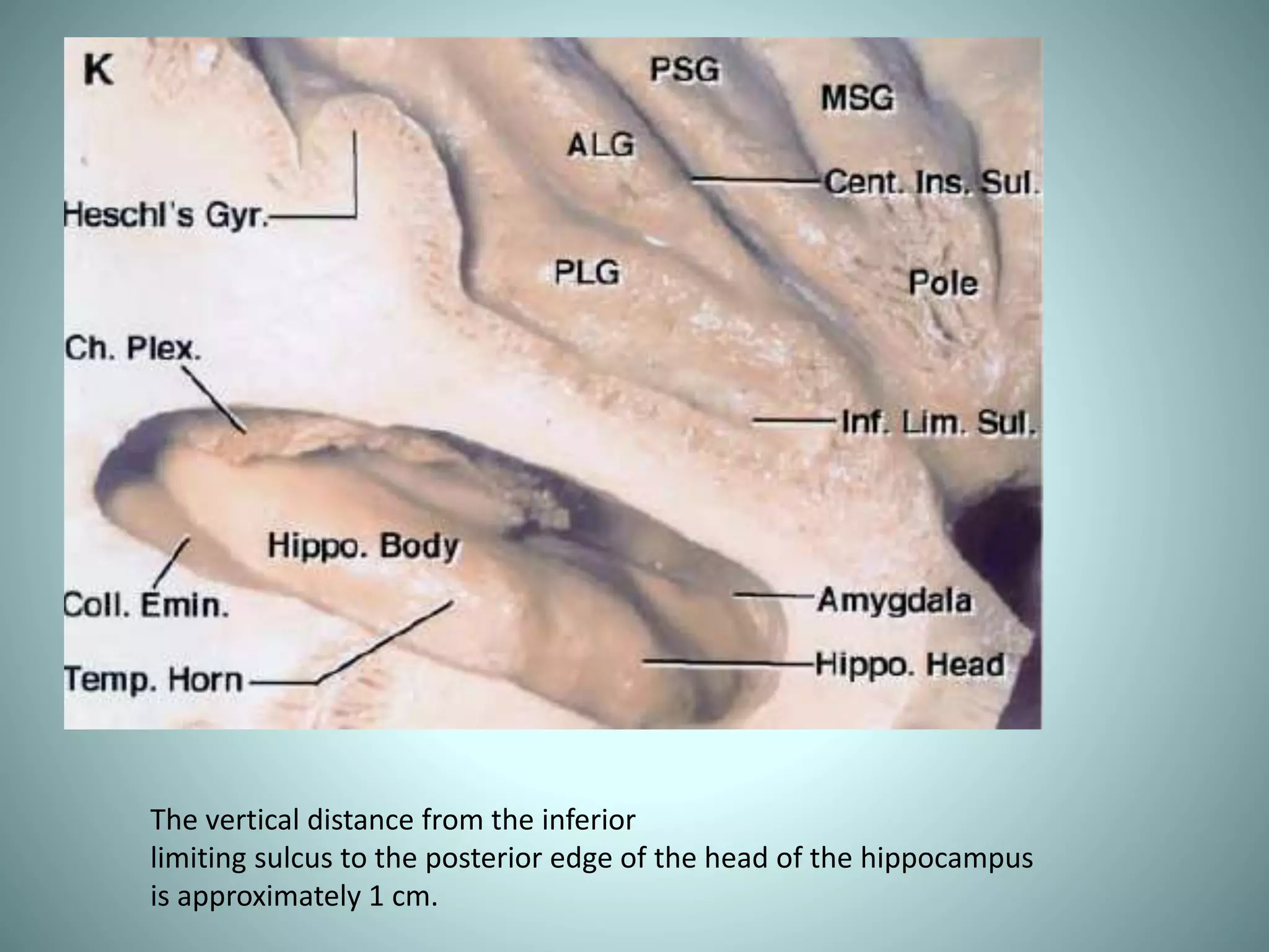 The vertical distance from the inferior
limiting sulcus to the posterior edge of the head of the hippocampus
is approximately 1 cm.
 