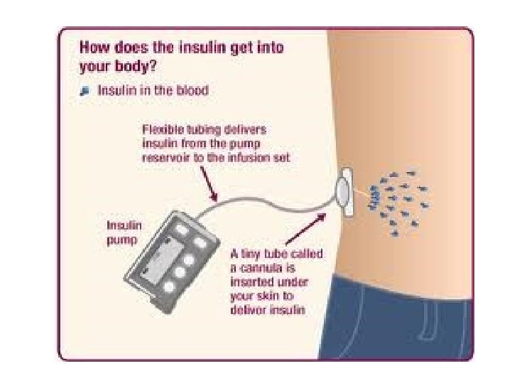 Insulin giving techniques
