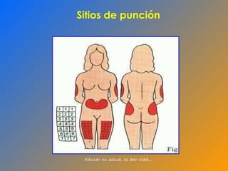 Sitios de punción 