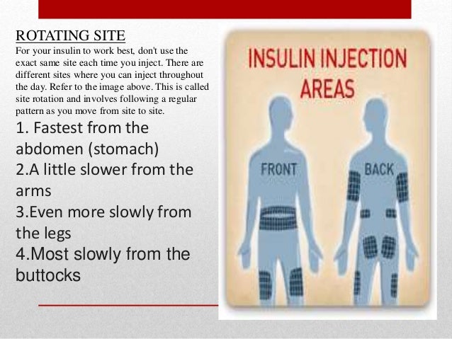 Rotating insulin injections