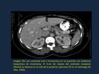imagen TAC con contraste oral e intravenosa en un paciente con evidencia
bioquímica de insulinoma. El 3-cm de mejora del contraste neoplasia
(flecha) se observa en la cola de la posterior páncreas (P) en el estómago (S)
(Yeo, 1993).
 