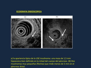 a) la apariencia típica de la USE insulinoma: una masa de 1,5 mm
hipoecoica bien definido en la mitad del cuerpo del páncreas. (B) Dos
insulinomas muy pequeñas (flechas) que mide menos de 5 mm en el
páncreas distal.
ECOGRAFIA ENDOSCOPICA
 