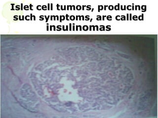 Islet cell tumors, producing
 such symptoms, are called
       insulinomas
 