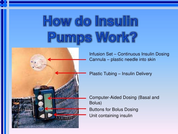 Insulin pump presentation