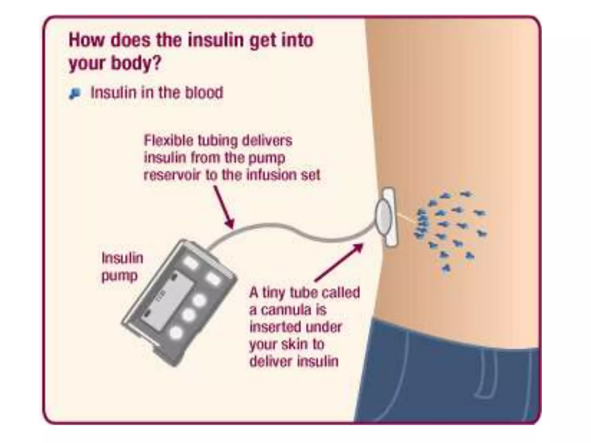 Insulin Therapy Of Diabetes Mellitus Pptx