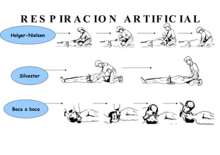RESPIRACION ARTIFICIAL Holger-Nielsen Silvester Boca a boca 