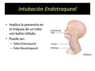 Intubación Endotraqueal
• Implica la presencia en
la tráquea de un tubo
con balón inflado.
• Puede ser:
– Tubo Orotraqueal
– Tubo Nasotraqueal
 