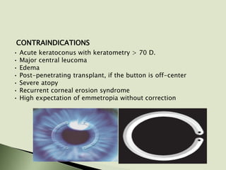 CONTRAINDICATIONS
• Acute keratoconus with keratometry > 70 D.
• Major central leucoma
• Edema
• Post-penetrating transplant, if the button is off-center
• Severe atopy
• Recurrent corneal erosion syndrome
• High expectation of emmetropia without correction
 