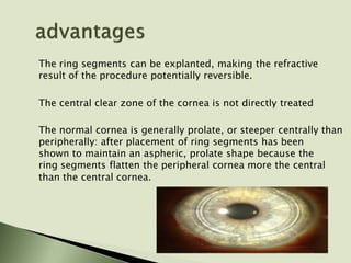 The ring segments can be explanted, making the refractive
result of the procedure potentially reversible.
The central clear zone of the cornea is not directly treated
The normal cornea is generally prolate, or steeper centrally than
peripherally: after placement of ring segments has been
shown to maintain an aspheric, prolate shape because the
ring segments flatten the peripheral cornea more the central
than the central cornea.
 
