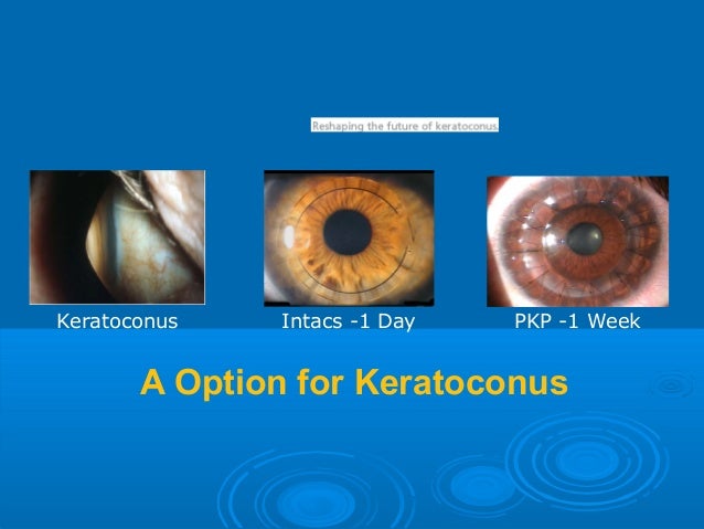 Intacs Corneal Inserts For Treatment Of Keratoconus And Ectasia - 