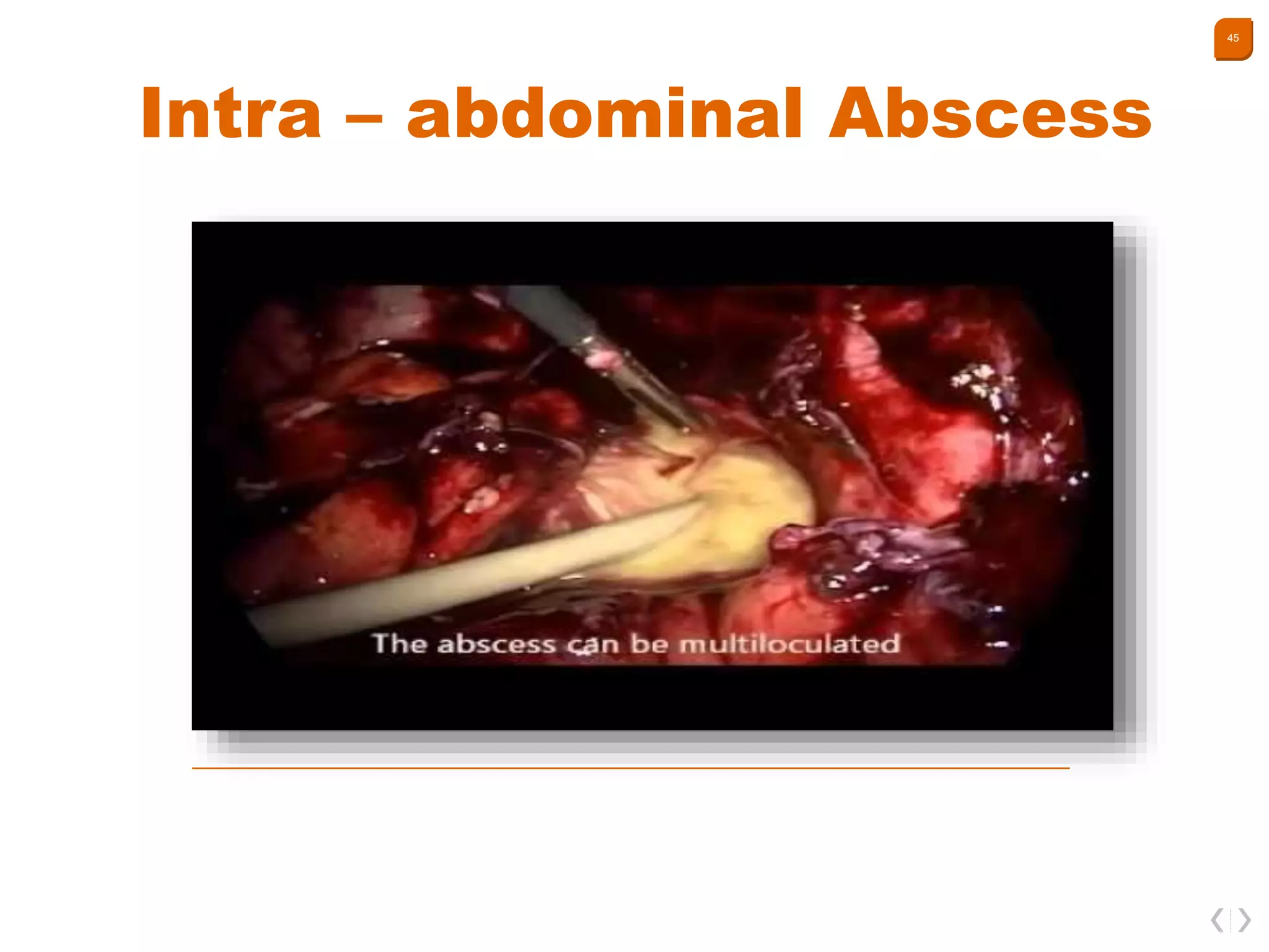 Intra-abdominal infections | PPTX
