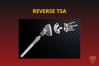 Integra_-_Reverse_Total_Shoulder_Arthroplasty.ppt