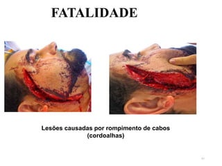 61
FATALIDADE
Lesões causadas por rompimento de cabos
(cordoalhas)
 