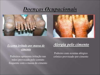 Alergia pelo cimento
Pedreiro com eczema alérgico
crônico provocado por cimento
Eczema irritado por massa de
cimento
Pedreiros apresenta irritação nas
mãos provocada pelo contato
frequente com a massa do cimento
 
