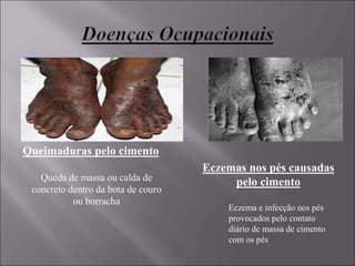 Eczemas nos pés causadas
pelo cimento
Queimaduras pelo cimento
Queda de massa ou calda de
concreto dentro da bota de couro
ou borracha
Eczema e infecção nos pés
provocados pelo contato
diário de massa de cimento
com os pés
 