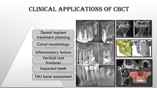 CLINICAL APPLICATIONS OF CBCT
Dental implant
treatment planning
Canal morphology
Inflammatory lesions
Vertical root
fractures
Impacted teeth
TMJ bone assessment
 