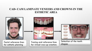 CAD- CAM LAMINATE VENEERS AND CROWNS IN THE
ESTHETIC AREA
Facial reference lines
for esthetic planning
Tracing and reference lines
for virtual wax-up creation.
Selection of the teeth
shapes
 