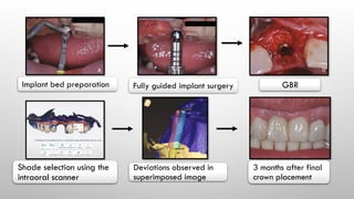 Implant bed preparation Fully guided implant surgery GBR
Shade selection using the
intraoral scanner
Deviations observed in
superimposed image
3 months after final
crown placement
 