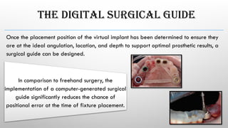 THE DIGITAL SURGICAL GUIDE
Once the placement position of the virtual implant has been determined to ensure they
are at the ideal angulation, location, and depth to support optimal prosthetic results, a
surgical guide can be designed.
In comparison to freehand surgery, the
implementation of a computer-generated surgical
guide significantly reduces the chance of
positional error at the time of fixture placement.
 