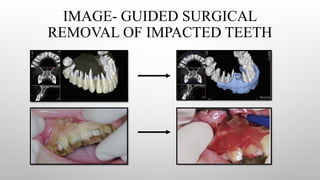 IMAGE- GUIDED SURGICAL
REMOVAL OF IMPACTED TEETH
 