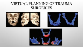 VIRTUAL PLANNING OF TRAUMA
SURGERIES
 