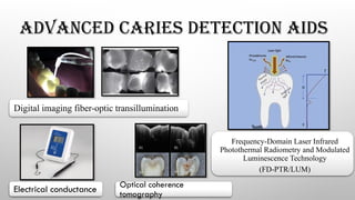 ADVANCED CARIES DETECTION AIDS
Digital imaging fiber-optic transillumination
Electrical conductance
Optical coherence
tomography
Frequency-Domain Laser Infrared
Photothermal Radiometry and Modulated
Luminescence Technology
(FD-PTR/LUM)
 